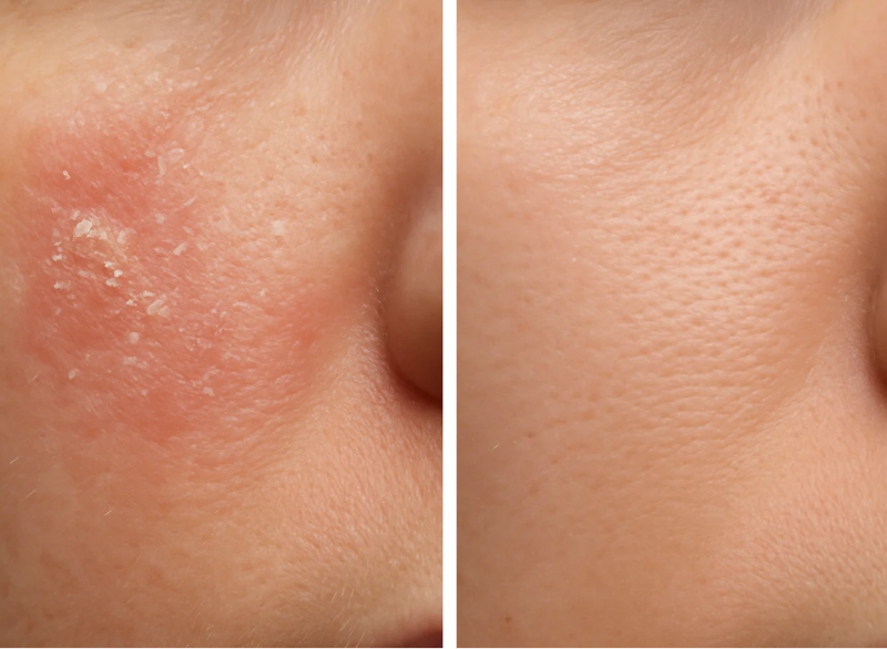 Before & after seborrheic dermatitis