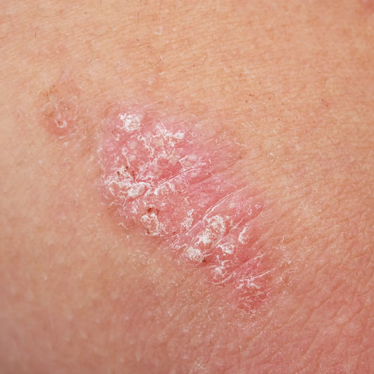 Why Psoriasis Plaques Come Back in the Same Spots