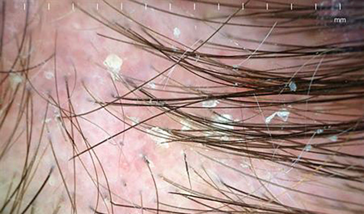 Seborrheic Dermatitis as a “Skin Metabolism Mismatch” Disorder