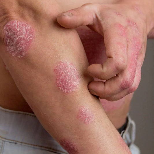 Psoriasis Myths vs Facts: Separating Truth from Fiction