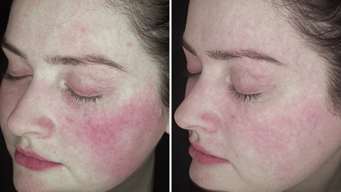 Can Rosacea Be Triggered by Skincare Meant for “Sensitive Skin”?