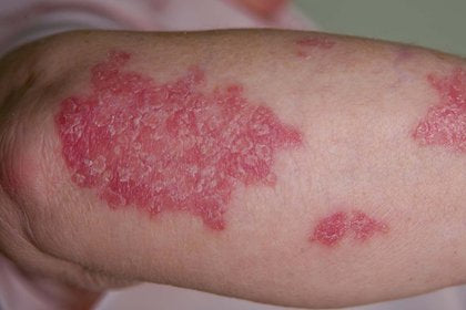Why Psoriasis Is Increasingly Seen as a Whole-Body Inflammatory Condition