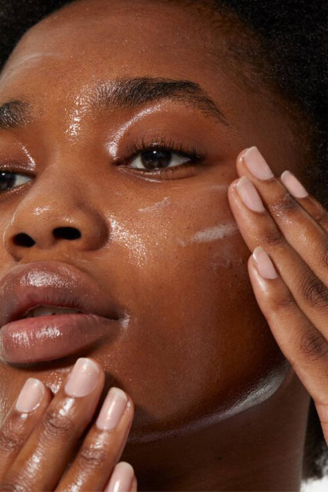 The Role of Yeast (Malassezia) in Seborrheic Dermatitis