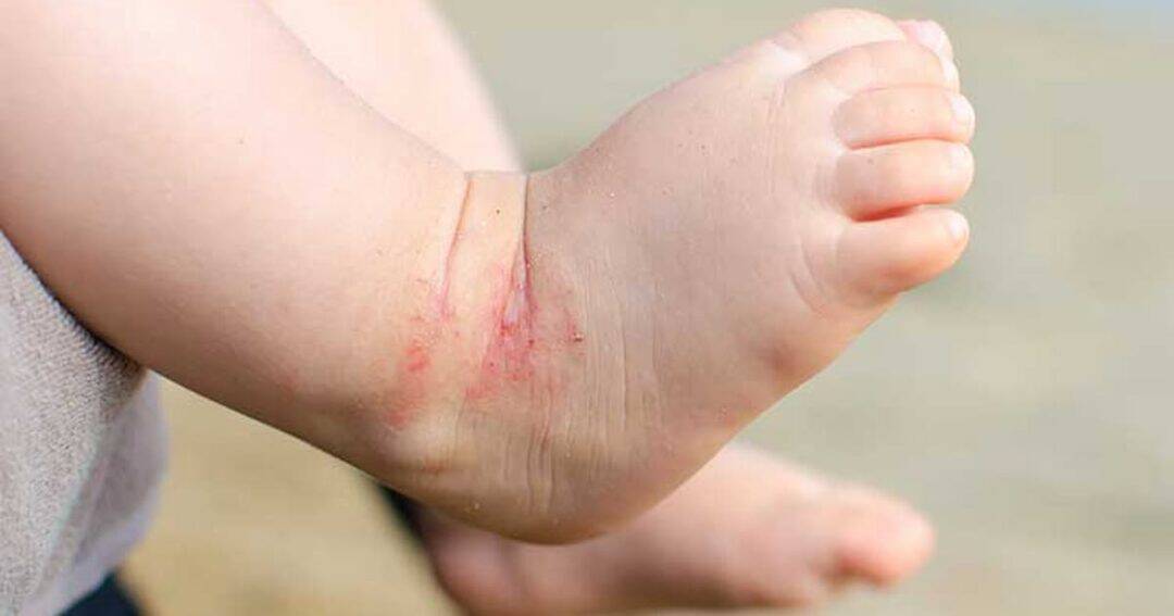 Creating a Skincare Routine for Eczema-Prone Skin: Simple Steps for Healthier-Looking Skin