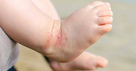 Creating a Skincare Routine for Eczema-Prone Skin: Simple Steps for Healthier-Looking Skin