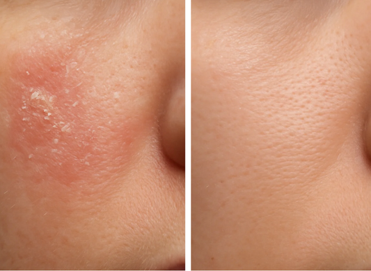 Can Diet Aﬀect Seborrheic Dermatitis? The Gut–Skin Connection