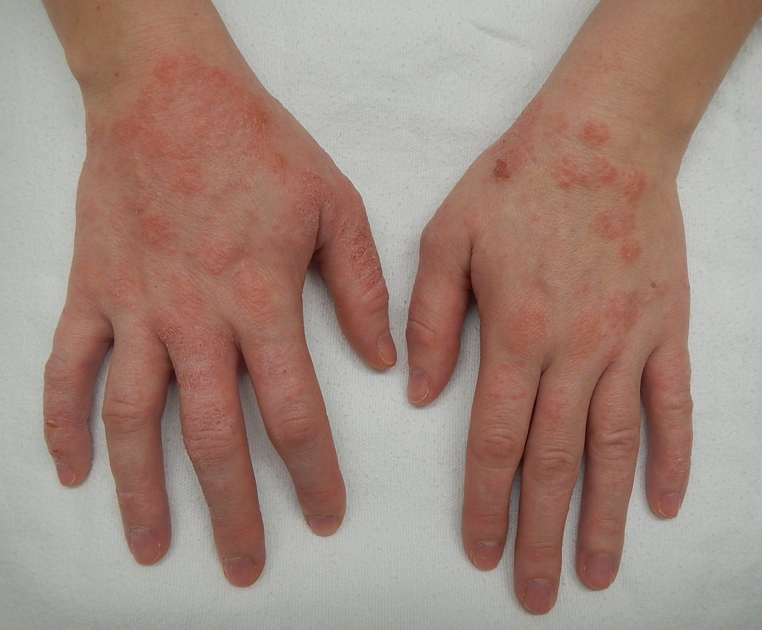 Understanding Eczema: What Your Skin Is Trying to Tell You