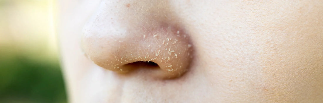 Why have I Woken Up with Dry, Flaky Skin?