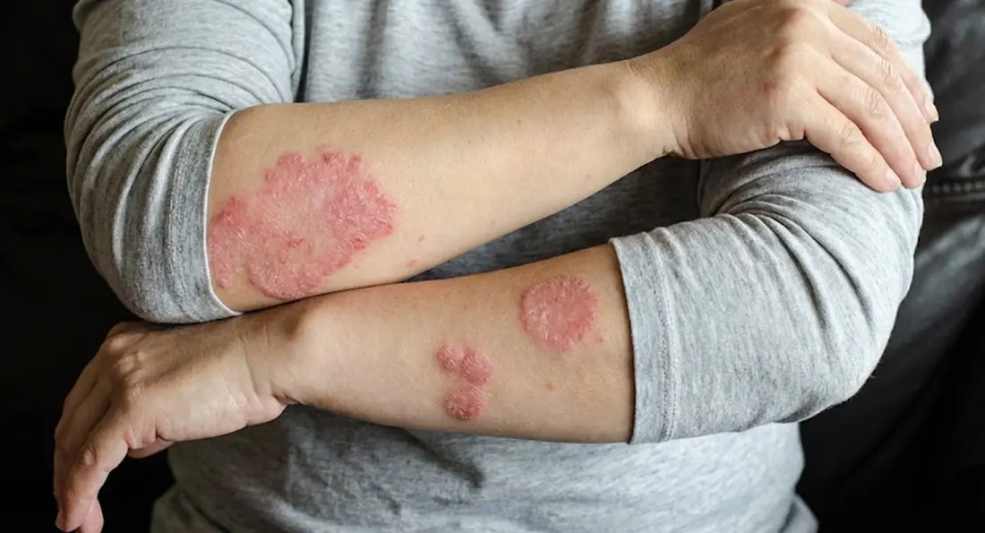 Can Climate Change Worsen Eczema?
