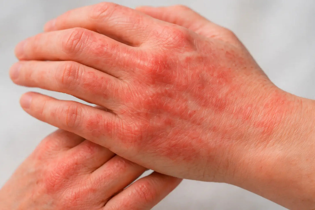 Eczema Myths Explained: Understanding Your Skin Beyond the Misconceptions