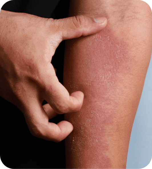 Understanding Eczema: Why Your Skin Flares Up and How to Support It