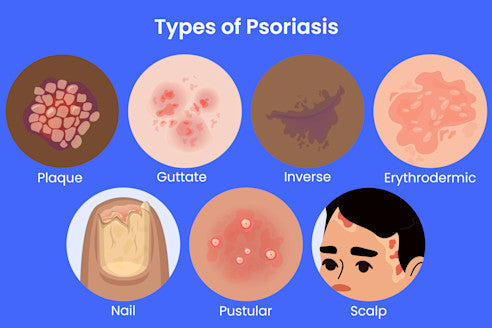 Understanding Psoriasis: What It Is, What Causes It and How to Care for Your Skin