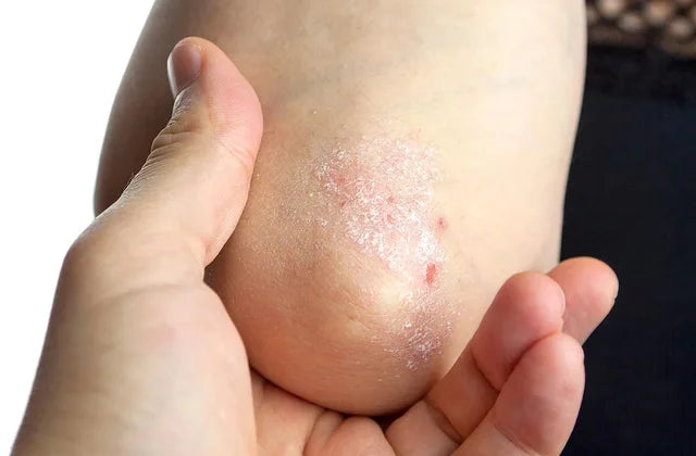 Psoriasis 101 — Symptoms, Causes, Treatments, and Daily Management Tips