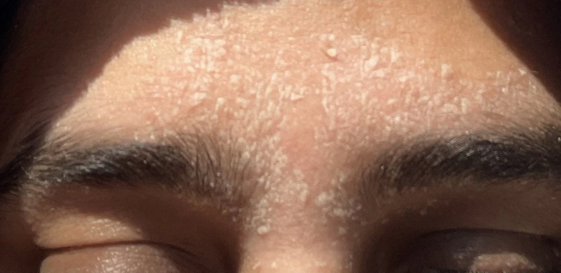 Seborrheic Dermatitis: The Oil–Microbe Negotiation Problem