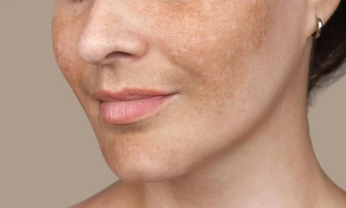 Long-Term Scarring and Pigmentation: What Seborrheic Dermatitis Can Leave Behind
