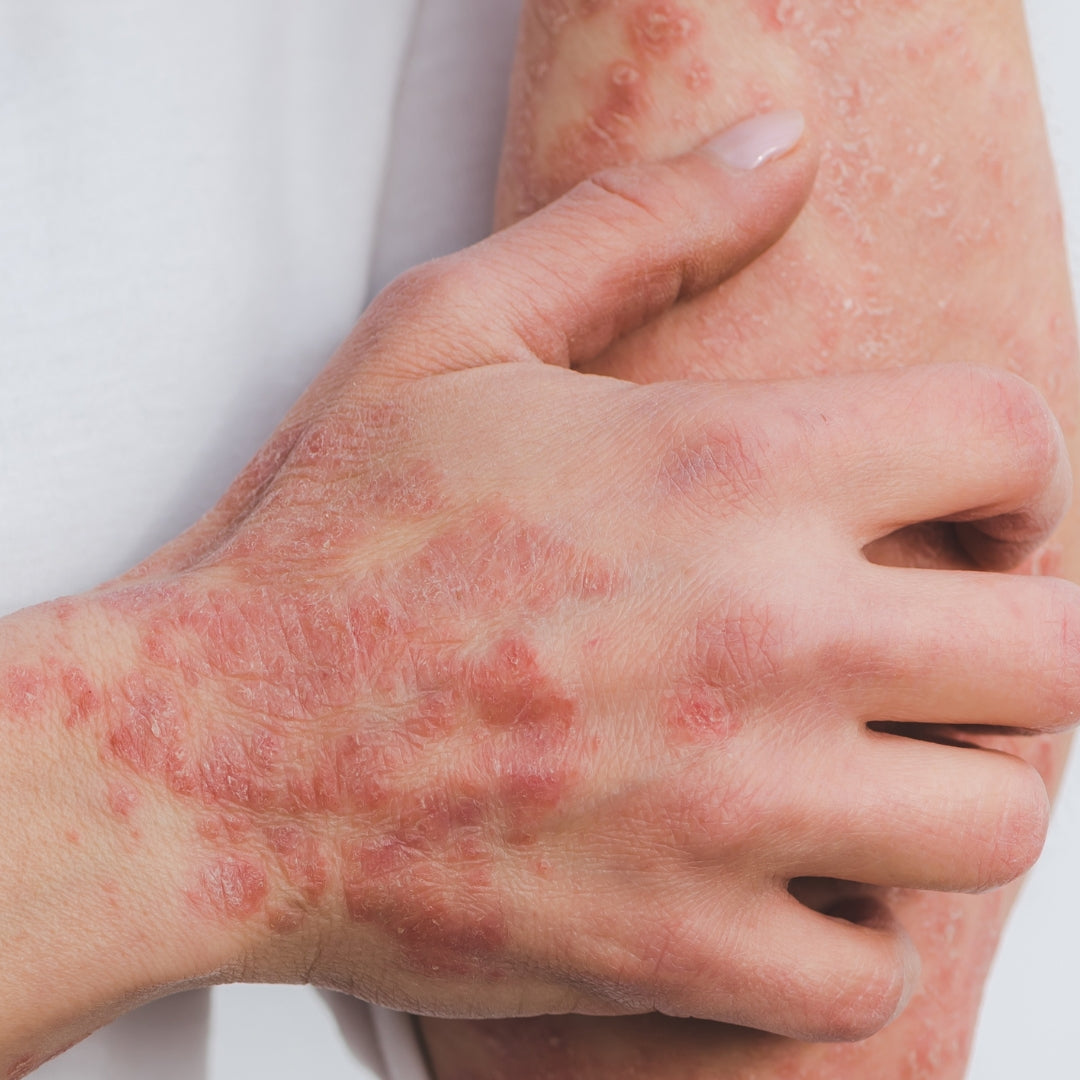 Can Infections Trigger Psoriasis Flares?
