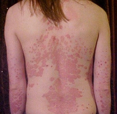 The Best Daily Skincare Routine for Psoriasis-Prone Skin