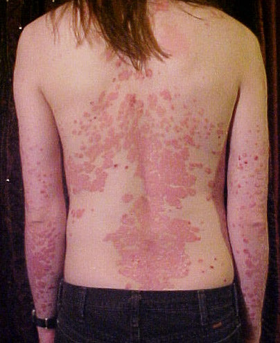 Psoriasis Is Not Just a Skin Condition — It’s an Immune System Running at Full Volume