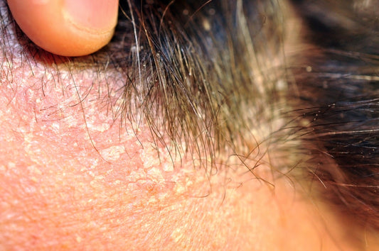 Seborrheic Dermatitis as an “Environmental Translation Error"