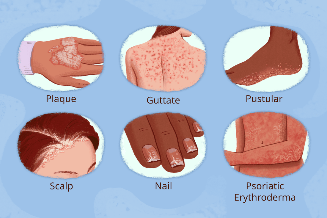 Psoriasis in Thin vs Thick Skin Areas