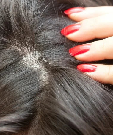 Malassezia Yeast and Dandruff: What’s the Connection?