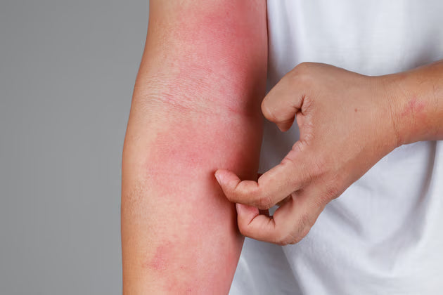Eczema Is More Than Dry Skin — It’s an Exhausted Barrier Living in a Hyperalert World