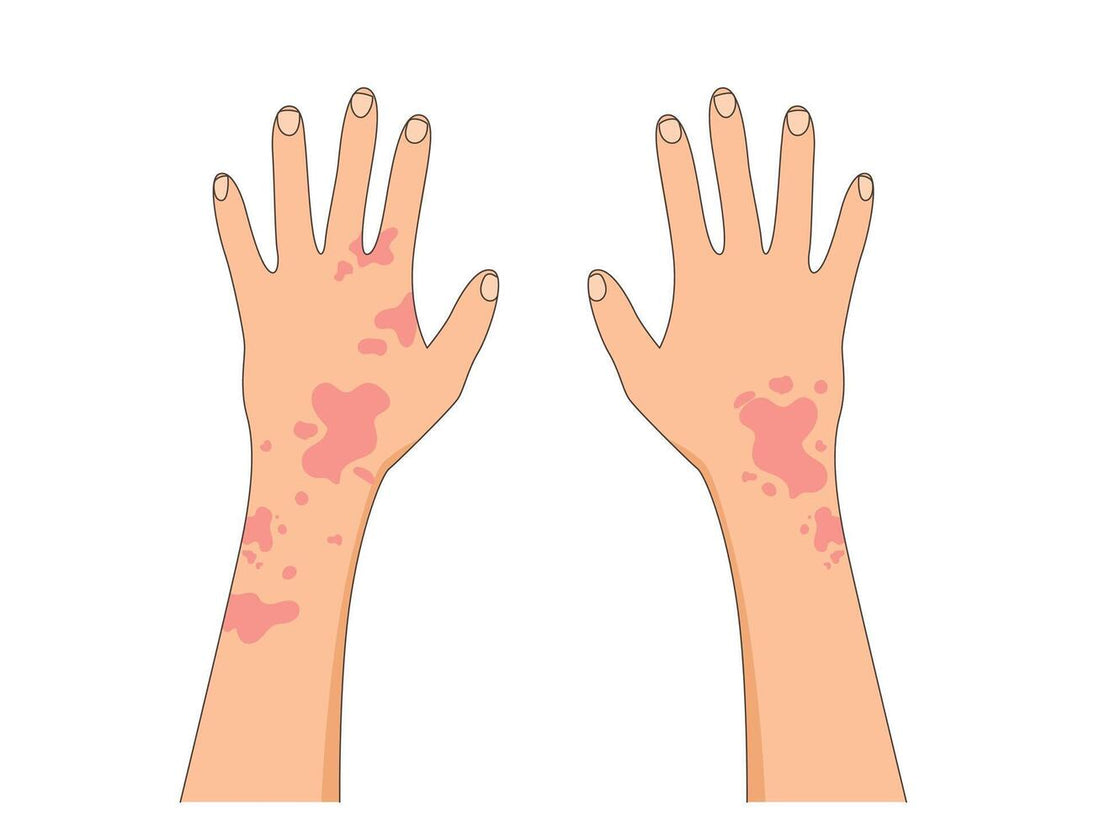 Managing Multiple Skin Conditions — Seborrheic Dermatitis, Eczema, and Psoriasis Together