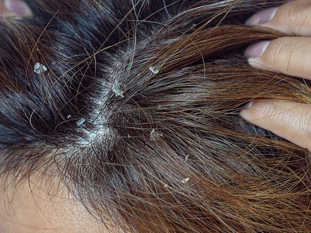 The Microbiome Approach — Treating the Scalp as an Ecosystem, Not a Problem Area