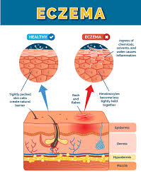 Understanding Eczema — Why It Happens and How to Manage It Naturally and Medically