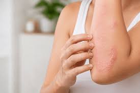 Why Does Eczema Keep Coming Back? Understanding the Skin Barrier and Flare-Up Cycle