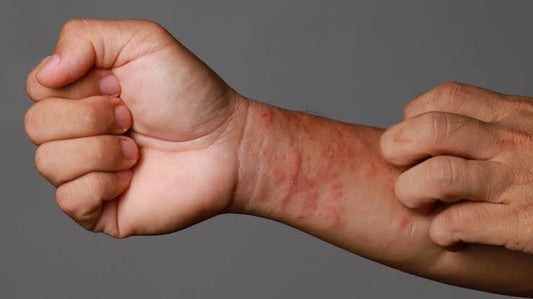 Eczema and the Skin Barrier: Understanding What Your Skin Really Needs