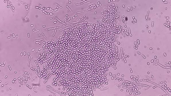 Why Does Dandruff Keep Coming Back? The Role of Malassezia and Seborrheic Dermatitis