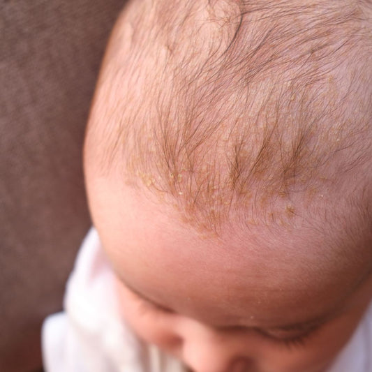 Seborrheic Dermatitis in Babies: Cradle Cap Myths and Facts