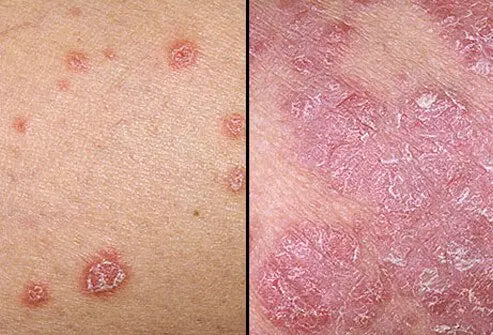 Psoriasis Is Not Just a Skin Condition: Understanding Systemic Inflammation