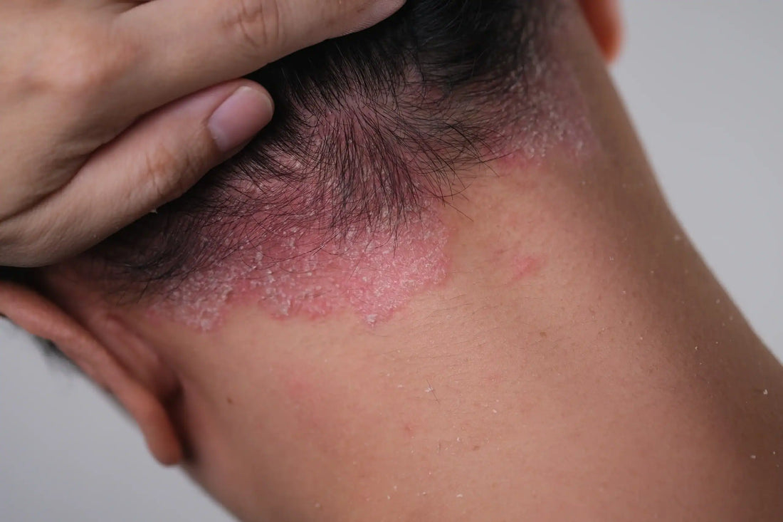Psoriasis Triggers — Why Flare-Ups Happen When Life Feels Unrelated