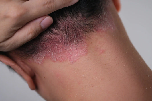 Psoriasis Triggers — Why Flare-Ups Happen When Life Feels Unrelated