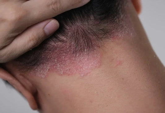 Why Seborrheic Dermatitis Comes Back After Treatment Stops