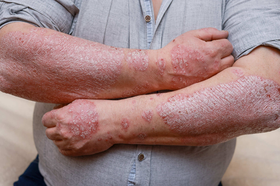 Why Psoriasis Keeps Coming Back — Understanding the “Cycle” Beneath the Skin
