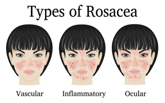 Why Rosacea Often Goes Undiagnosed for Years
