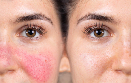 Rosacea and the Blood Vessels: Why Flushing Happens So Fast