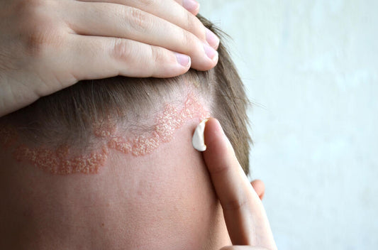 Seborrheic Dermatitis as a “Feedback Loop Between Inflammation and Self-Repair Overcorrection”