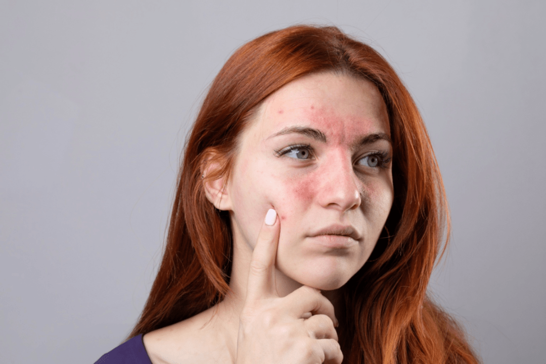 Why Is My Face Red & Blotchy? - Seb